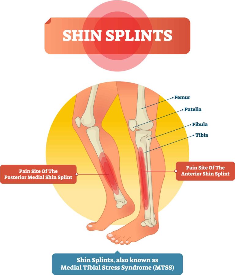 Top 10 Expert Cures for Shin Splints: Relieve Pain Effectively