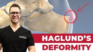 Haglund’S Bump | Balance Foot & Ankle