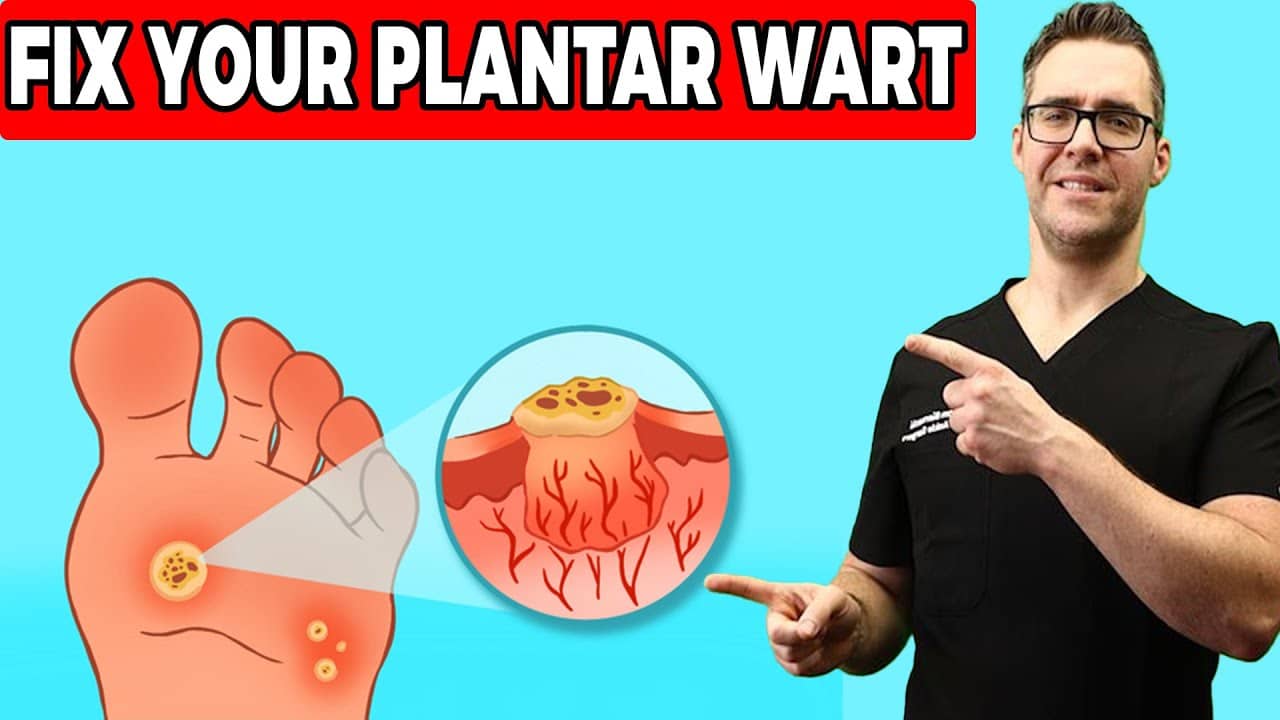 plantar wart removal