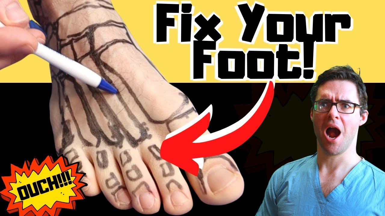 broken amp foot fracture treatments