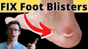How to Treat a Foot Blister