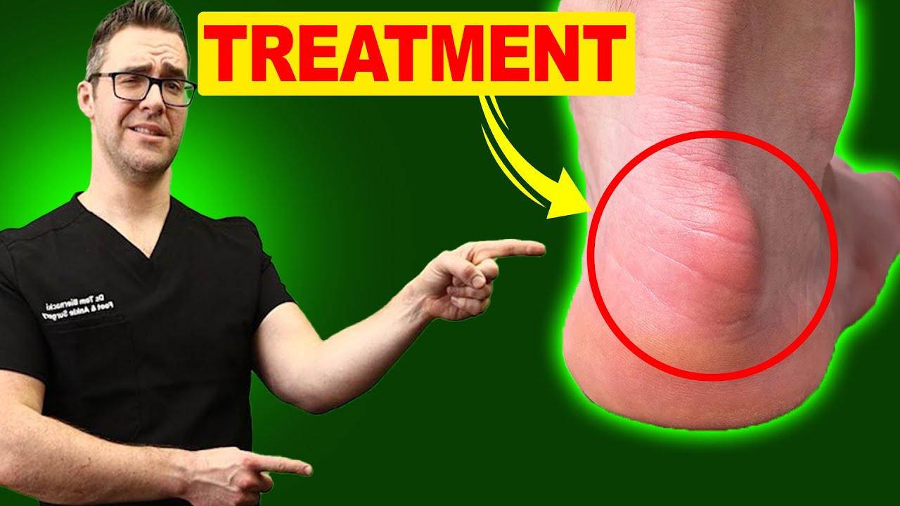 haglunds deformity amp haglunds bump treatment exercises amp stretching
