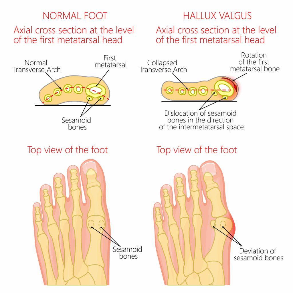 Bunion Foot Doctor in Michigan