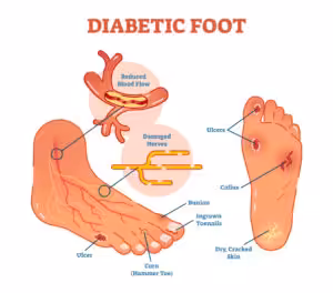 Diabetic Foot Doctor near me