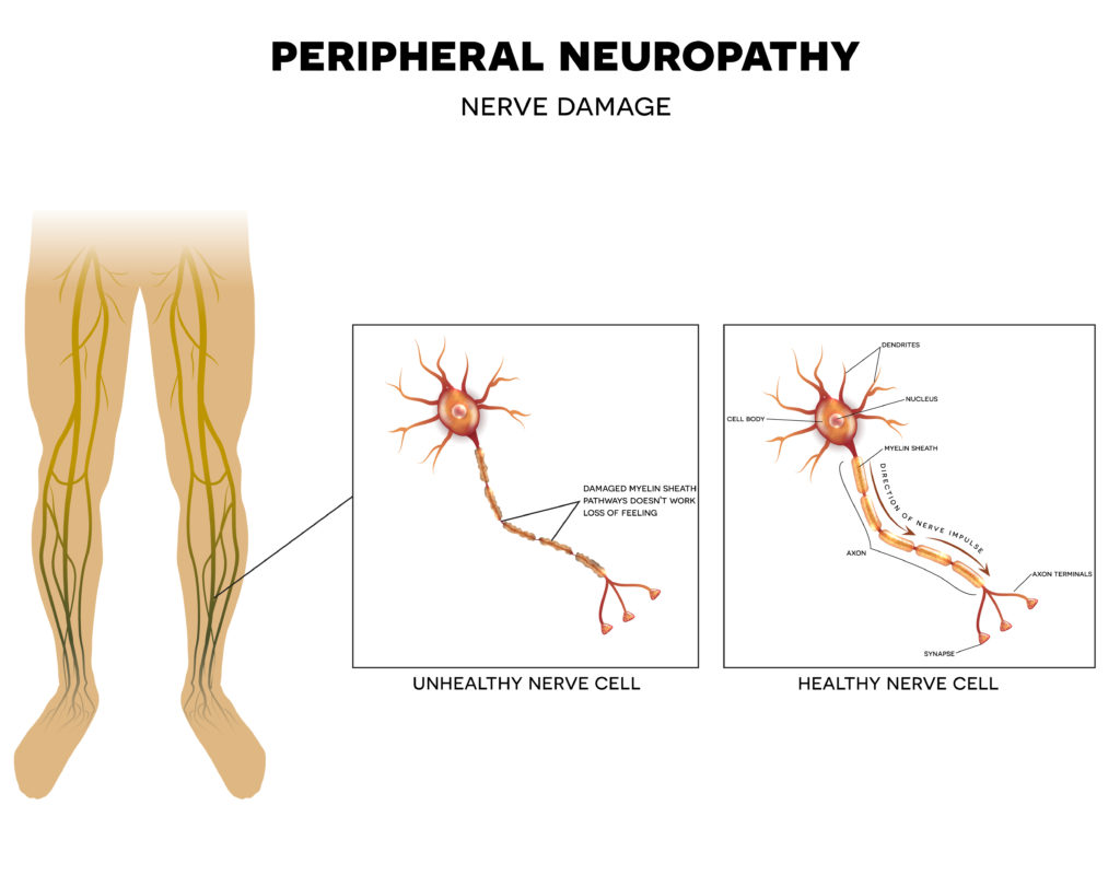 Diabetic foot care peripheral neuropathy