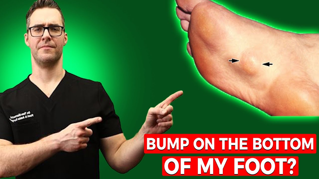 bump on the bottom of my foot