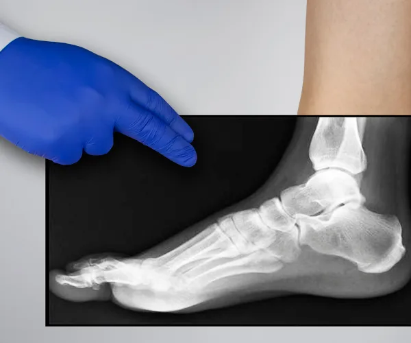 Lisfranc Injury treatment 2