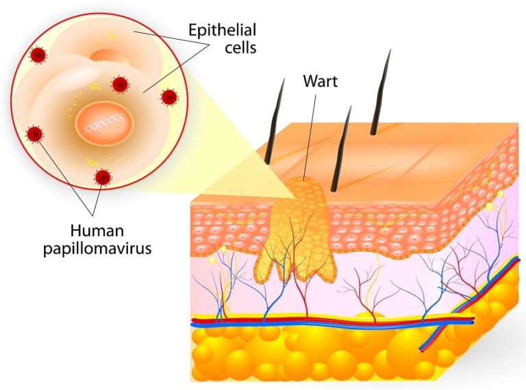 red bump on foot, white bumps on foot