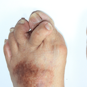 Second Toe Pain Treatment