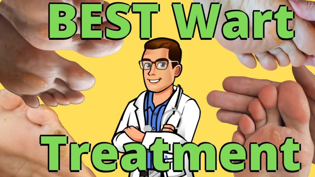 Plantar Wart Treatment Michigan 1 plantar wart treatment