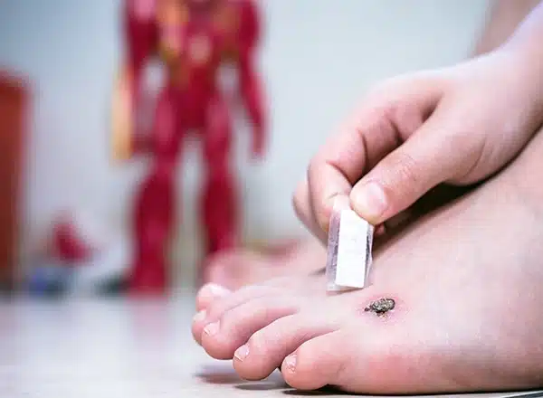 A child applying a adhesive bandage to a wart or wound on their foot, illustrating the need for proper pediatric foot care and protection.