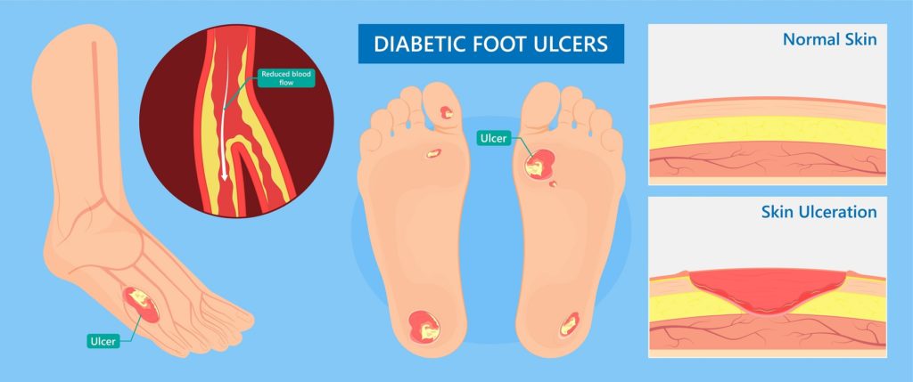 Diabetic Foot doctor wound care
