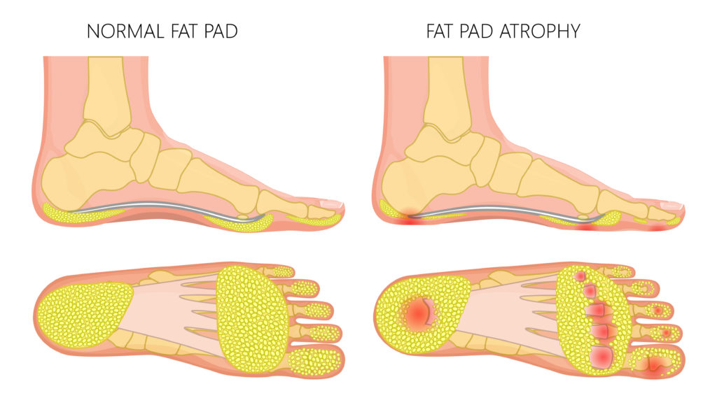 Heel pad syndrome treatment & heel pad symptoms
