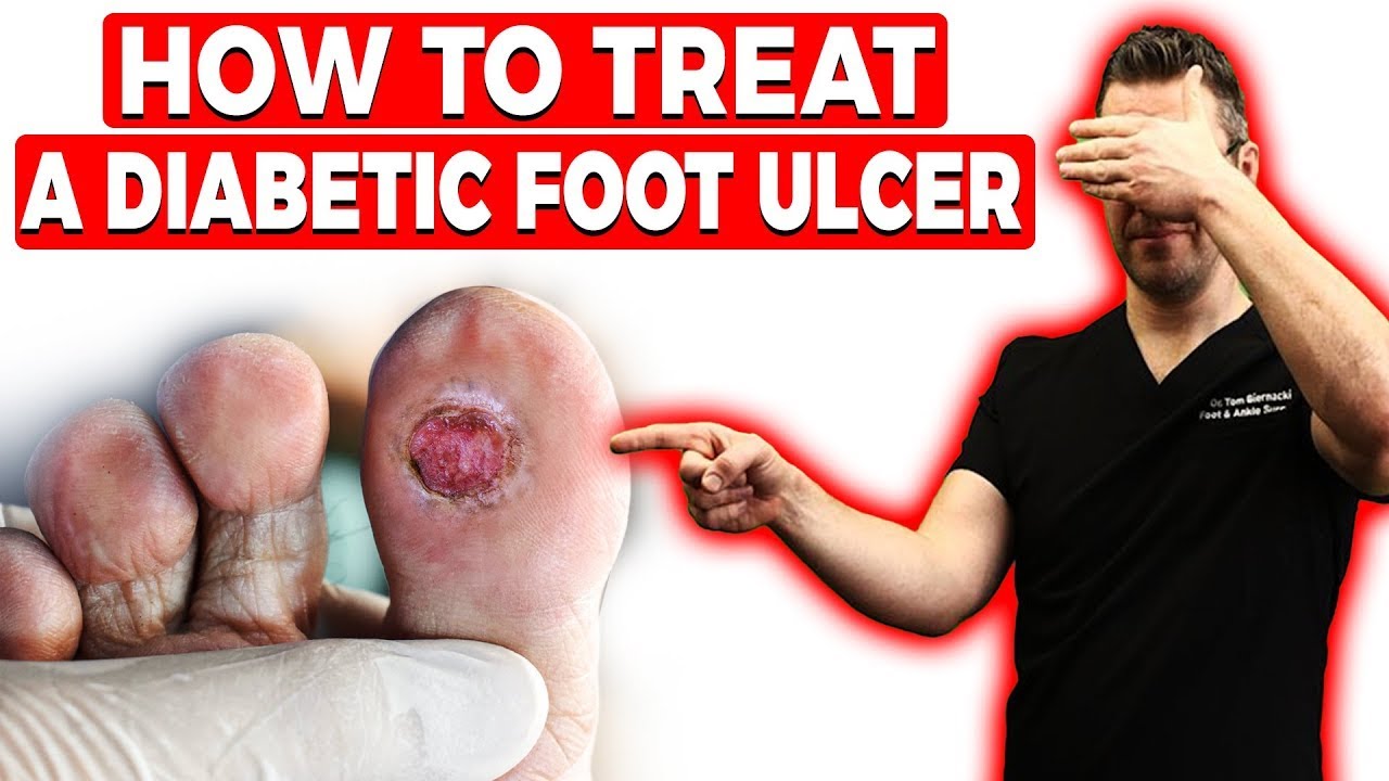 how to treat a diabetic foot ulcer early signs causes treatment