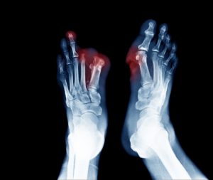 can you walk without a big toe