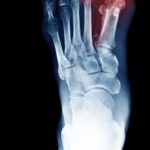 can you walk without your big toe