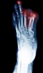 can you walk without a big toe