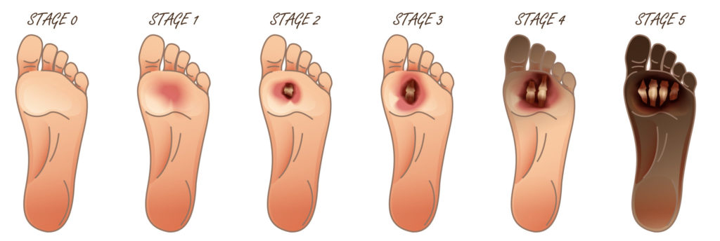 Early Stages of staph infection on toe staph infection on foot
