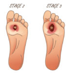 Early Stages of staph infection on toe staph infection on foot