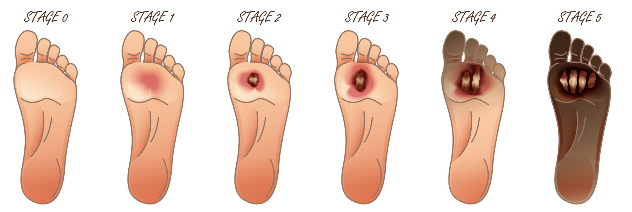 minor staphylococcus infection