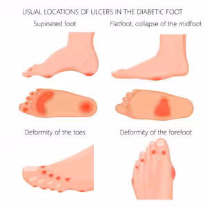can you still walk without a big toe​