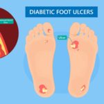 Diabetic Foot Ulcer and Peripheral Arterial Disease
