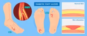 can you walk properly without a big toe