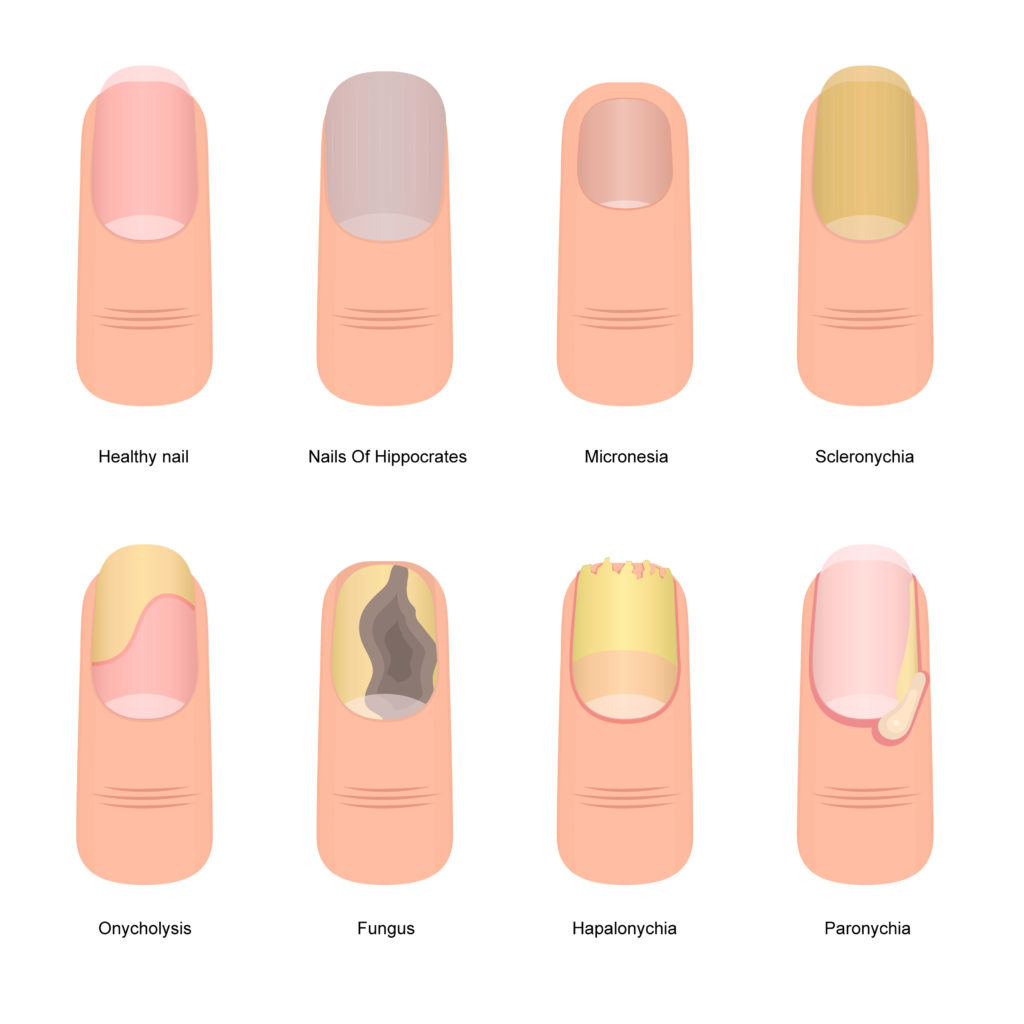 Different types of toenail diseases