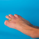 Can you walk without a big toe?