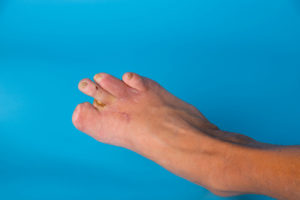 can you still walk without a big toe​
