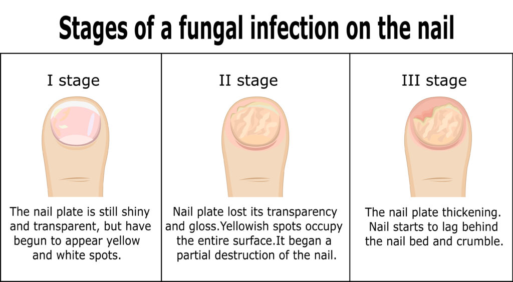 Stages of toenail fungus from a clear toenail to a thick yellow toenail