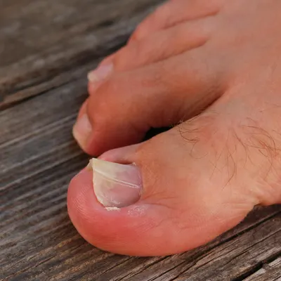horizontal lines on toenails