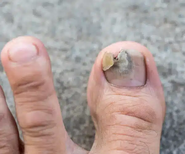 toenails peeling off