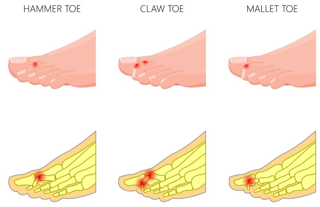 what causes toes to curl up