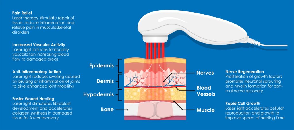 MLS laser therapy, cold laser therapy