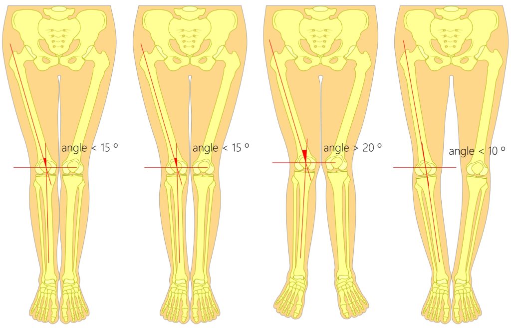 unequal leg length back pain, hip pain, knee pain treatment