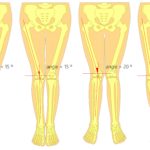 unequal leg length back pain, hip pain, knee pain treatment