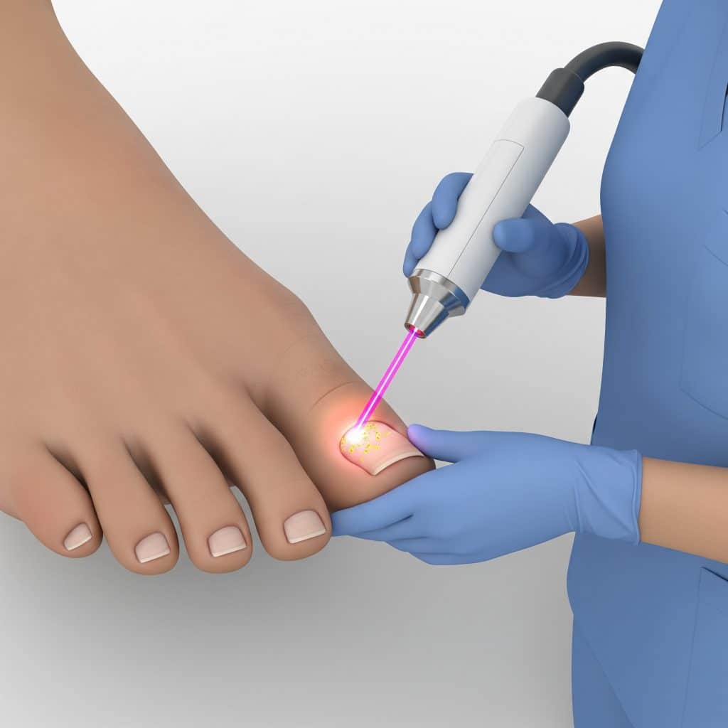 Laser treatment for toenail fungus 1 Laser treatment for toenail fungus