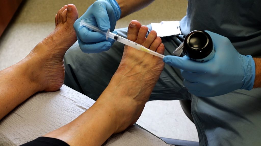 plantar fasciitis injection recovery time
