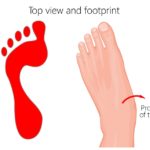 Overpronation can make you have wide feet and need shoes for wide feet
