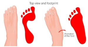 what is overpronation