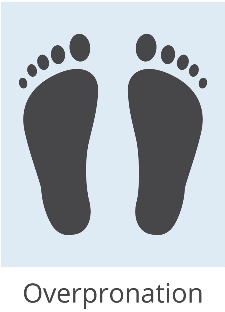 Overpronation Flat Feet Pain Treatment 15 overpronation foot