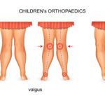 Overpronation knee hip pain 1