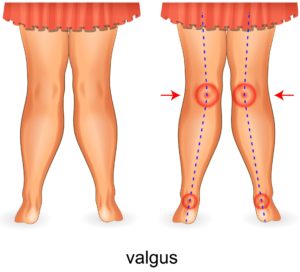 overpronation knee pain, overpronation hip pain