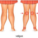 Overpronation knee hip pain 2