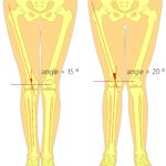 Overpronation knee hip pain angles 1