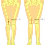 Overpronation knee & overpronation hip pain