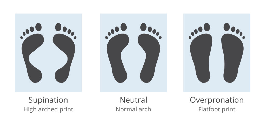 FIX High Arches & High Arch Feet [Pes Cavus Foot Deformity Treatment]