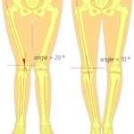 Overpronation knee & overpronation hip pain