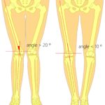 Overpronation vs supination foot knee hip back pain 2